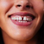 Diastema co to