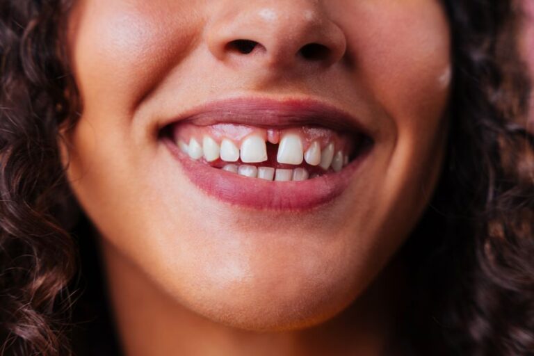 Diastema co to