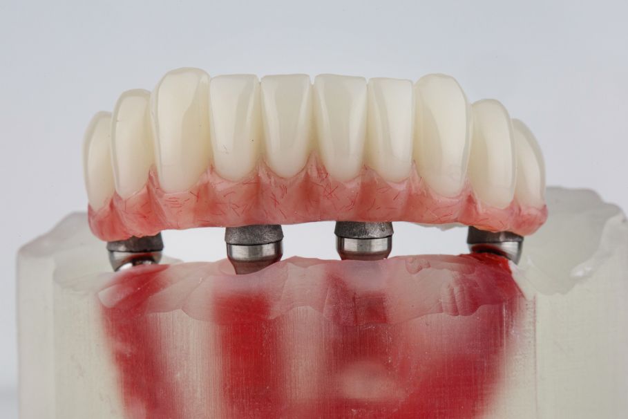 Jak wygląda proteza na zatrzaski i ile kosztuje