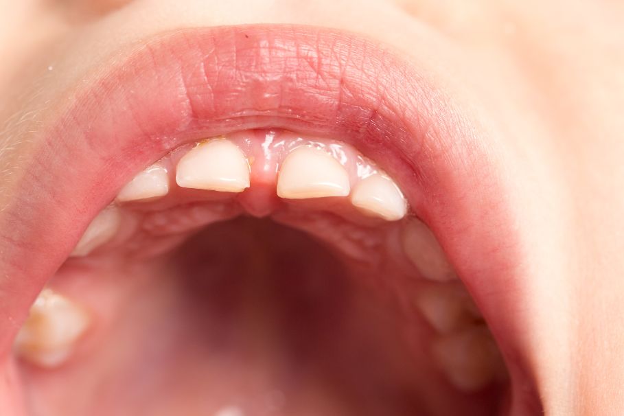 zęby mleczne u dziecka