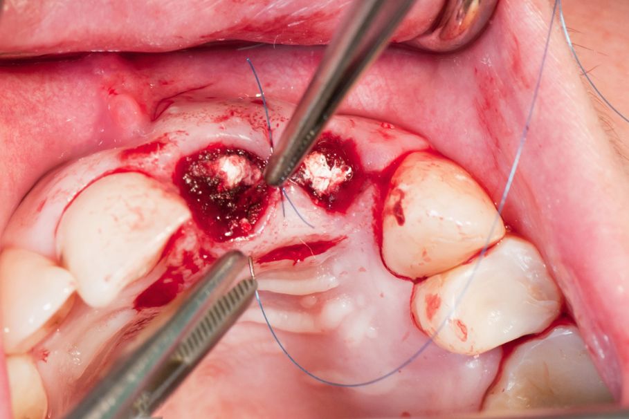 szwy po wyrwaniu zęba