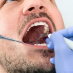 piaskowanie zębów